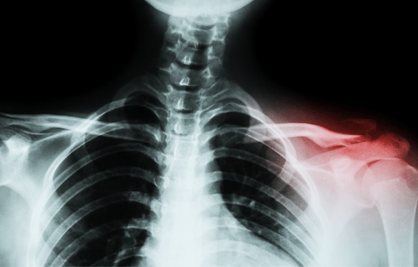 交通事故で鎖骨骨折 後遺障害の認定を受けるために必要なこと 交通事故専門弁護士やまケン